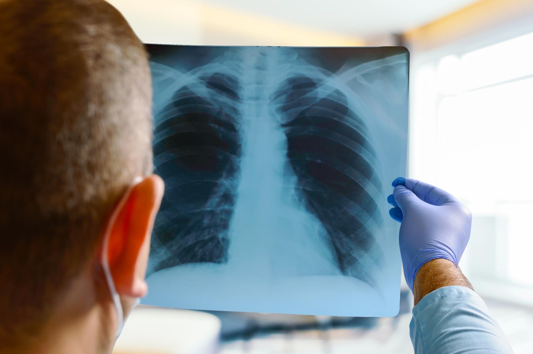 ¿Qué es el tamizaje de cáncer de pulmón y por qué es importante?